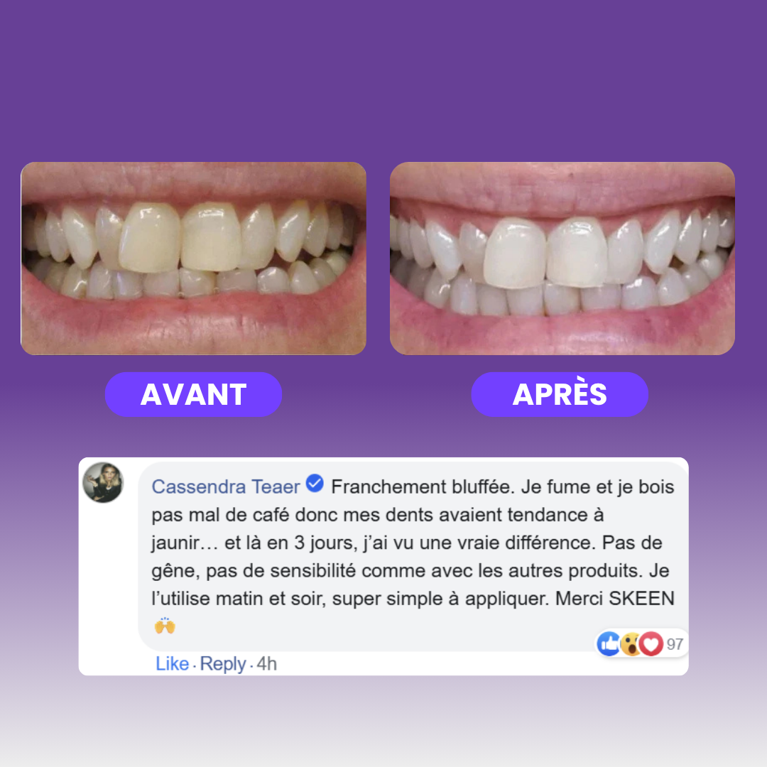 SKEEN™ - Stylo de Blanchiment Dentaire