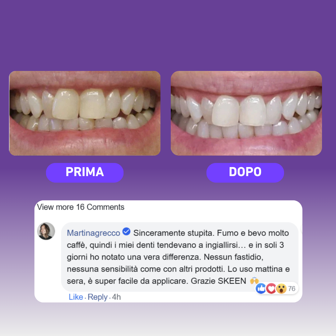 SKEEN™ – Penna Sbiancante per Denti