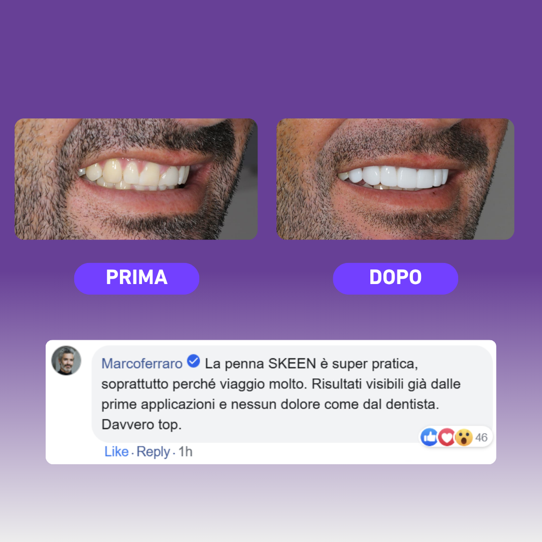 SKEEN™ – Penna Sbiancante per Denti